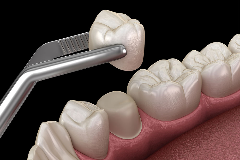 4-types-of-ceramic-crowns-for-your-dental-practice