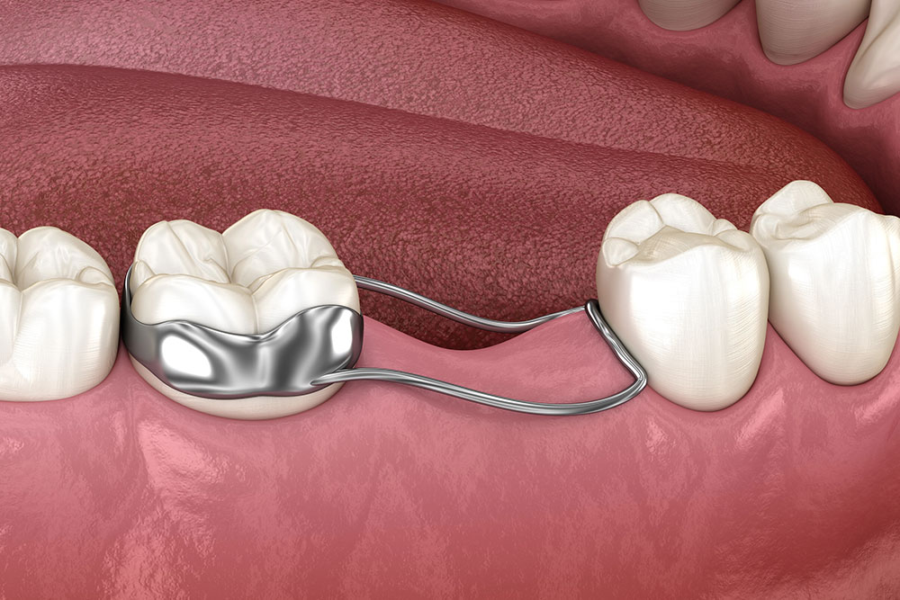 how-to-effectively-manage-the-dental-space-maintainer-process