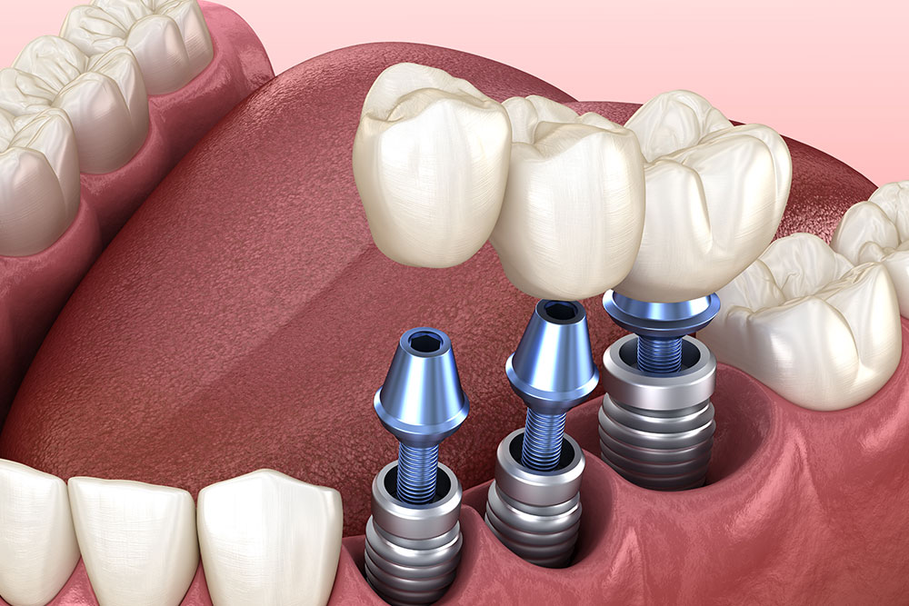 new-dental-implant-innovations-in-2025